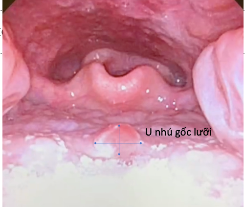 Hình ảnh nội soi u gốc lưỡi
