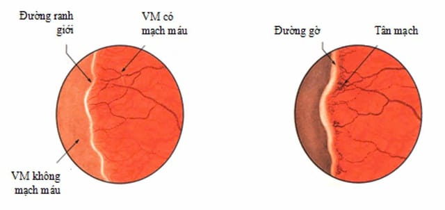 Bệnh lý võng mạc trẻ sinh non được chia làm 5 giai đoạn.