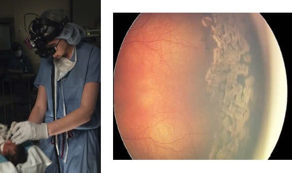 Thuốc tiêm nội nhãn thường được tiêm trực tiếp vào mắt tại phòng mổ, thời gian thực hiện nhanh.
