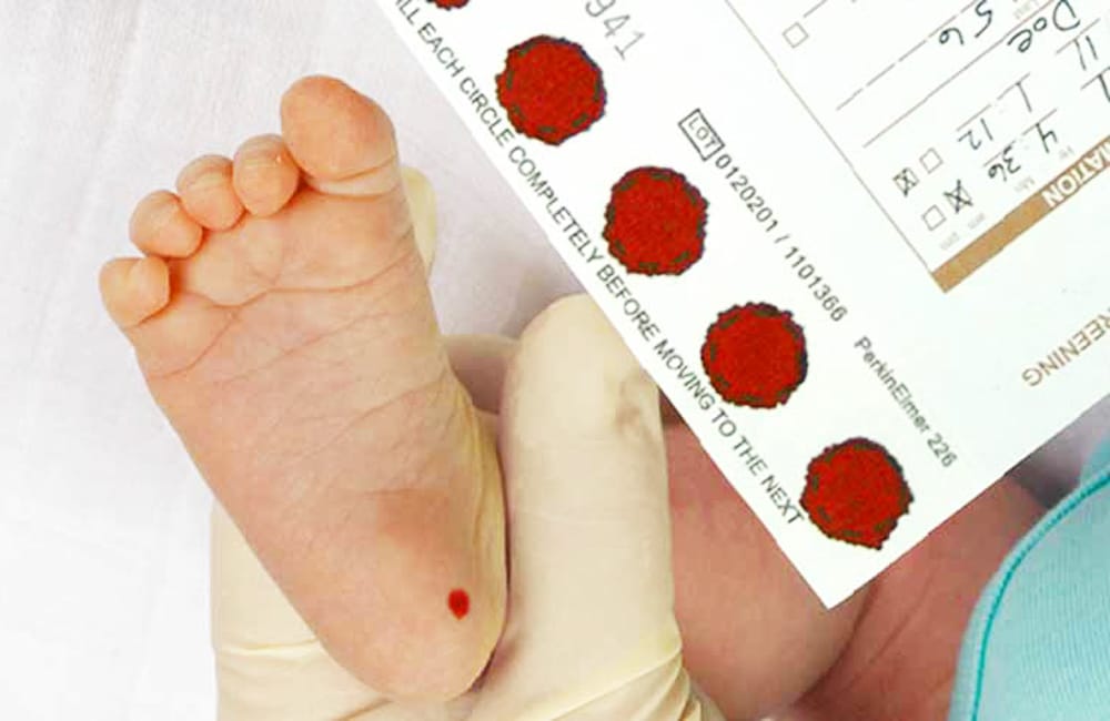 Sàng lọc sơ sinh là biện pháp phòng bệnh tích cực cho nhóm bệnh rối loạn chuyển hoá bẩm sinh axit hữu cơ, axit amin, axit béo