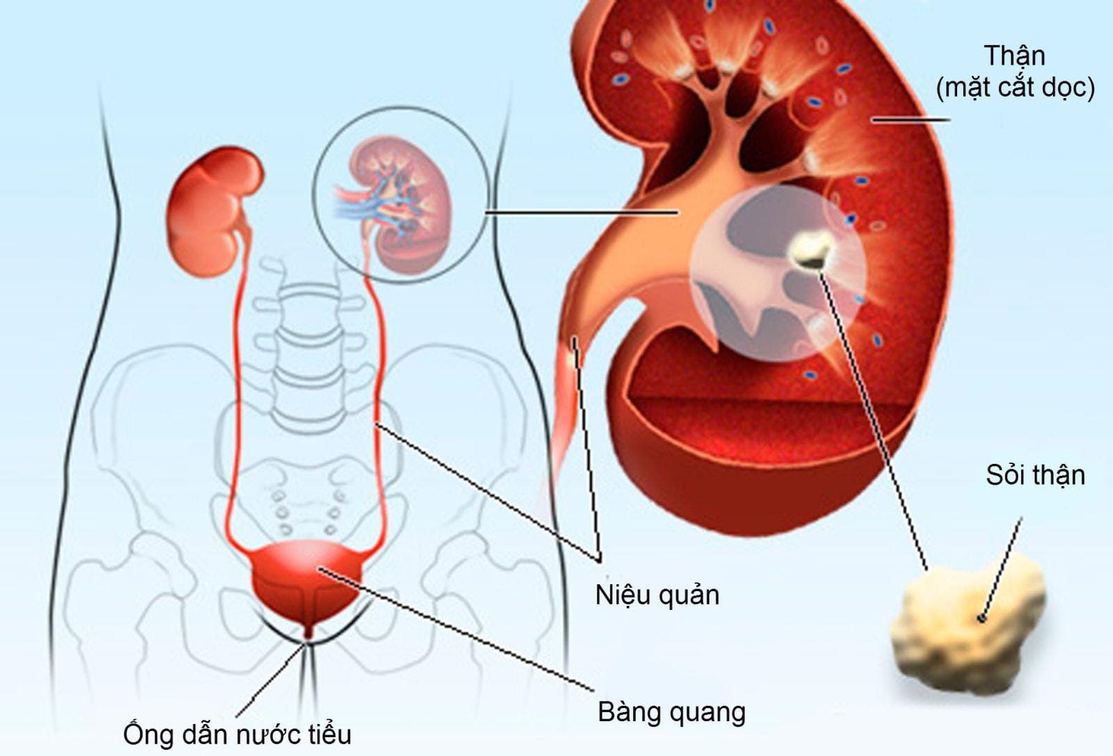 Sỏi đường tiết niệu có thể xuất hiện ở thận, niệu quản, bàng quang hoặc niệu đạo. Ảnh AI.