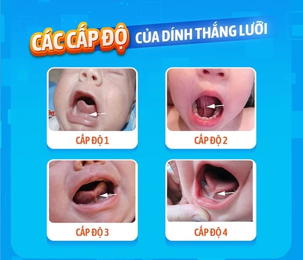 Dị tật bẩm sinh khiến trẻ khó bú, khó phát âm