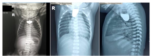 Teo thực quản nguy hiểm như thế nào?