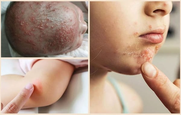 Viêm nang lông ở trẻ có nguy hiểm không?