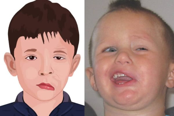 Cách xoa bóp, tập luyện cho trẻ bị liệt dây thần kinh số 7 ngoại biên tại nhà