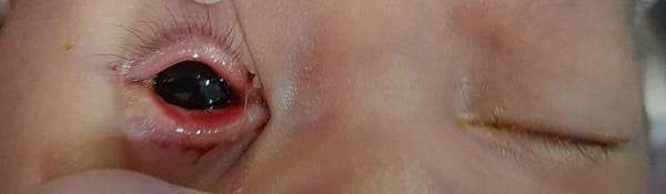 Sữa mẹ thật quý giá nhưng nếu nhỏ vào mắt trẻ có thể gây mù