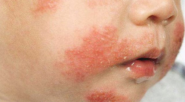 Dị ứng sữa bò ở trẻ em: Triệu chứng và cách xử trí