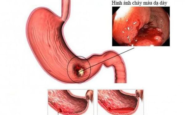 Xuất huyết tiêu hóa ở trẻ em: Nguyên nhân và dấu hiệu cha mẹ cần biết để phát hiện sớm