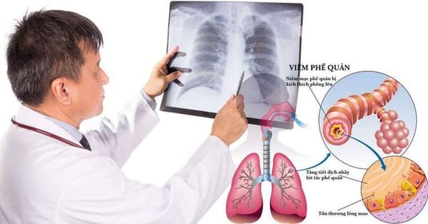 Bệnh viêm tiểu phế quản ở trẻ: Nhận biết, điều trị và những lưu ý