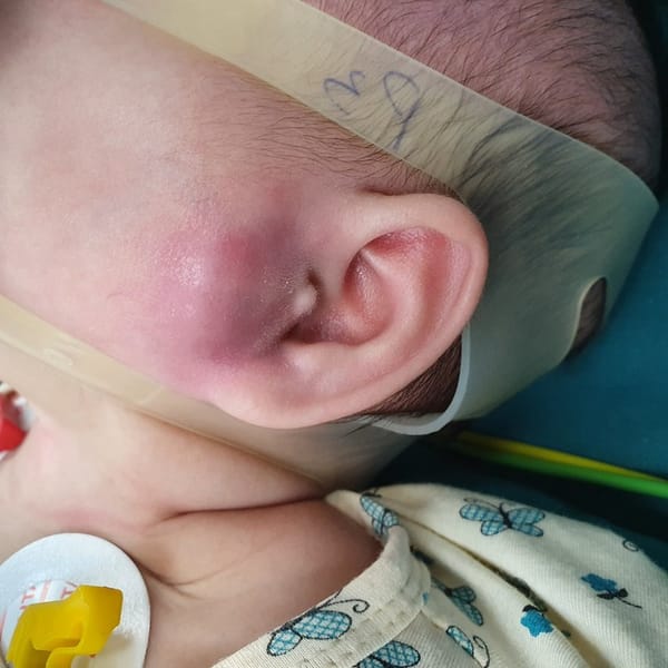 Nhọt ống tai ở trẻ nhỏ