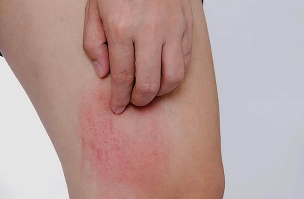 Viêm khớp vảy nến ở trẻ em và cách điều trị