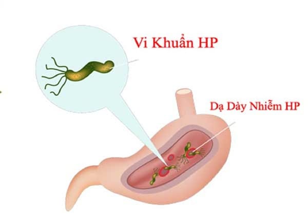 Cảnh giác với viêm loét dạ dày do vi khuẩn HP ở trẻ