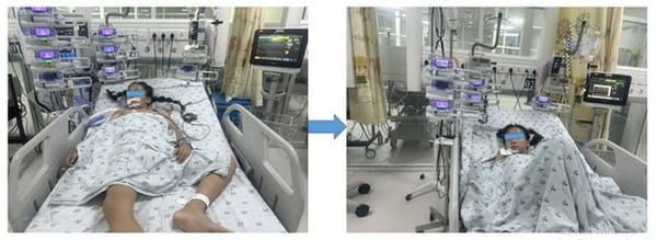 Mệt sau chạy bộ, bé gái 11 tuổi được phát hiện dị dạng mạch vành hiếm có, nguy cơ đột tử cao