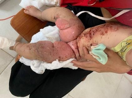 Bé 7 tháng bỏng nước canh, cảnh giác và phòng ngừa tai nạn bỏng ở trẻ