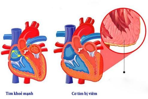 Cảnh giác với bệnh viêm cơ tim ở trẻ