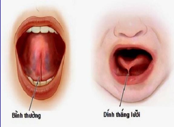 Hóa ra đây là nguyên nhân khiến trẻ dù lớn vẫn nói "ngọng líu ngọng lô"
