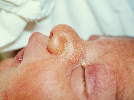 Xử trí đúng cách mụn hạt kê ở trẻ sơ sinh