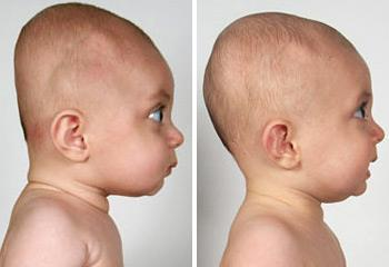 Chứng đầu bẹp ở trẻ sơ sinh - Lời khuyên cho cha mẹ