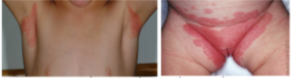 Bệnh vảy nến ở trẻ em: Tổn thương và những điều cha mẹ cần lưu ý