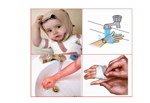 Để tránh tai nạn bỏng cho con, cha mẹ cần làm gì?