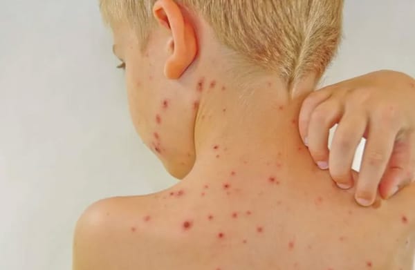 Nguy hiểm tiềm ẩn của bệnh Kawasaki không điển hình ở trẻ nhỏ