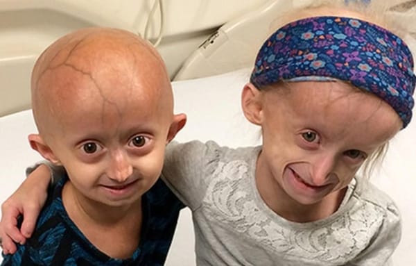 Trẻ nhỏ già đi như người già do bí ẩn gen lỗi trong hội chứng Progeria