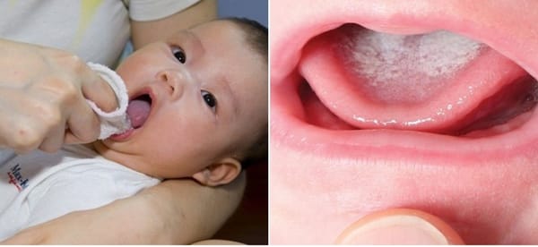 Vệ sinh đúng cách khi bé bị tưa miệng