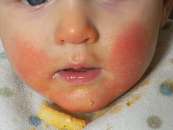 Các yếu tố làm tăng nguy cơ gây dị ứng thức ăn ở trẻ mà cha mẹ cần biết