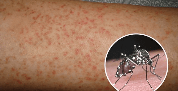 Trẻ mắc sốt xuất huyết cần làm gì để nhanh khỏi bệnh?