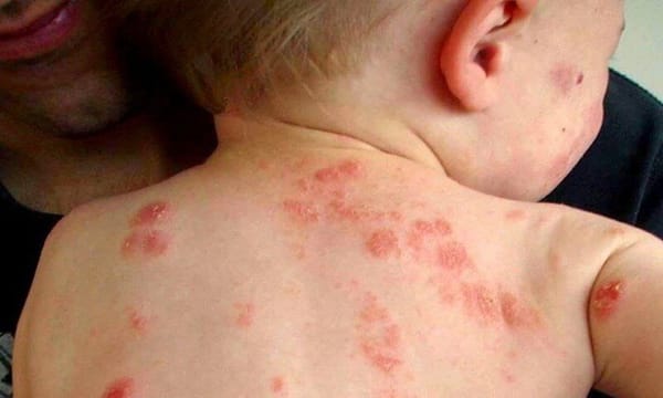 Mùa hè cảnh giác với chốc lở ngoài da ở trẻ em