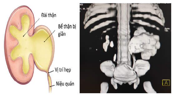 Cảnh giác với bệnh hẹp khúc nối bể thận - niệu quản
