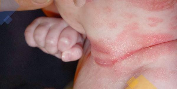 Viêm da tiết bã ở trẻ: Phòng và trị thế nào?