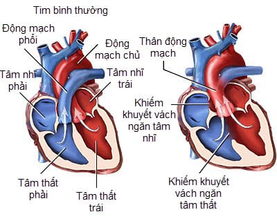 Bệnh tim bẩm sinh: Nguyên nhân, biểu hiện, khi nào cần phẫu thuật?