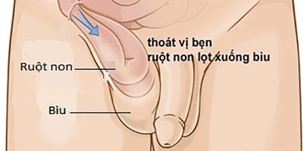 Thoát vị bẹn ở trẻ em- Phát hiện càng muộn càng nguy hiểm