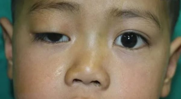 Trẻ mệt bất thường có thể mắc rối loạn nhược cơ bẩm sinh