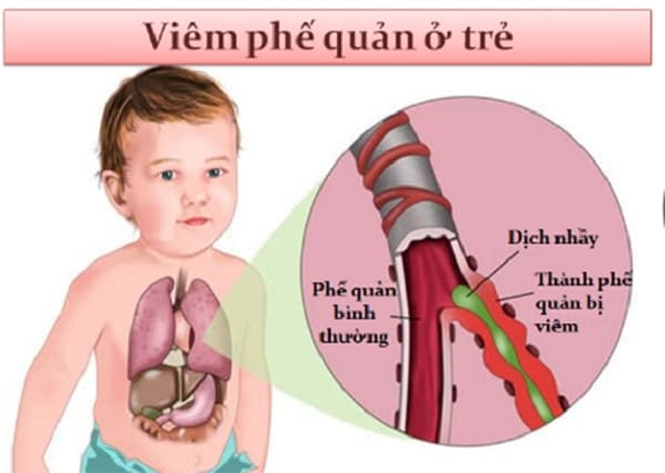 Hen phế quản ở trẻ mùa lạnh, cách xử trí đúng cơn hen cấp