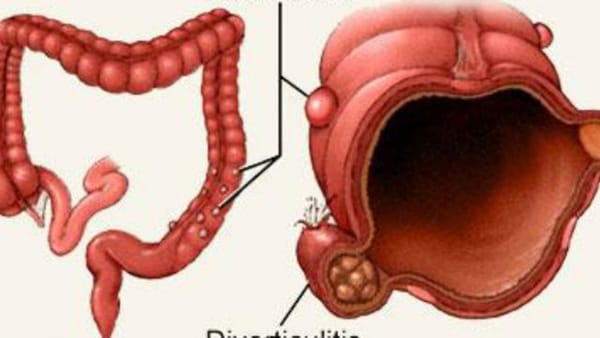 Đau bụng, nôn - Cảnh giác với túi thừa Meckel biến chứng xuất huyết tiêu hóa