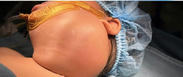 Các biến chứng của u nang bạch huyết ở trẻ em