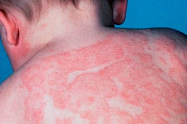 Trẻ sơ sinh có mắc vảy nến không?