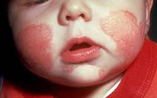 Nguyên nhân gây chàm sữa ở trẻ và cách chăm sóc khi mùa đông về