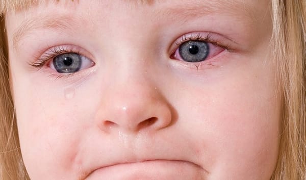 Viêm kết mạc ở trẻ em phòng và phát hiện như thế nào?