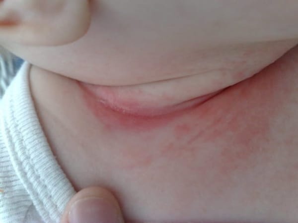 Nấm kẽ ở trẻ hay bị ở đâu và có biểu hiện thế nào?