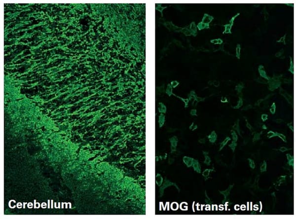 Nhận biết bệnh tự miễn thần kinh kháng thể kháng MOG ở trẻ em