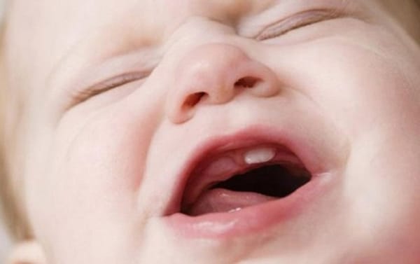 Bệnh viêm lợi ở trẻ em do nguyên nhân nào?