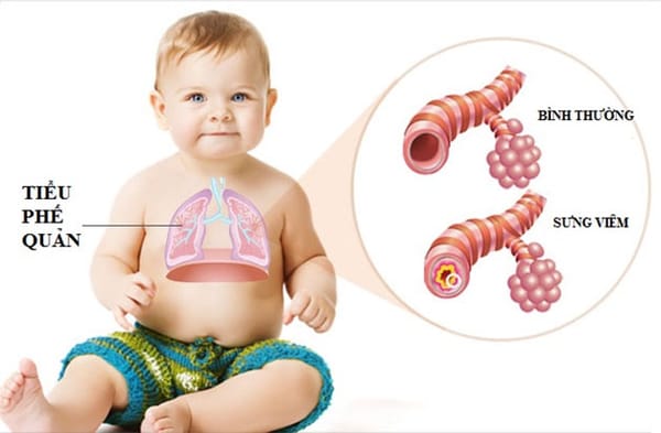 Chữa viêm tiểu phế quản ở trẻ như thế nào?