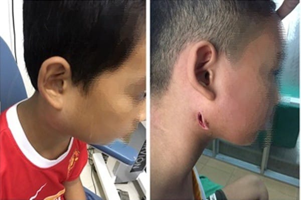 Bệnh Whitmore ở trẻ - Những thông tin cha mẹ cần biết