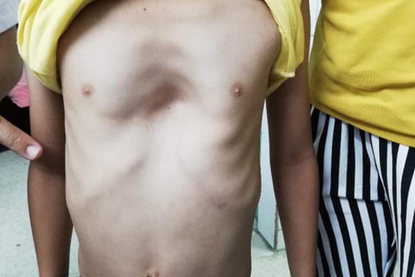 Bệnh lõm lồng ngực ở trẻ cần phát hiện sớm