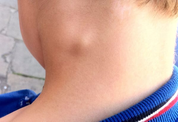 Nổi hạch ở trẻ là biểu hiện của bệnh gì?