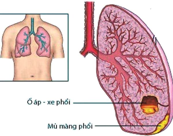 Áp xe phổi ở trẻ và những biến chứng