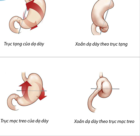 Xoắn dạ dày ở trẻ em rất nguy hiểm, cha mẹ cần phát hiện sớm